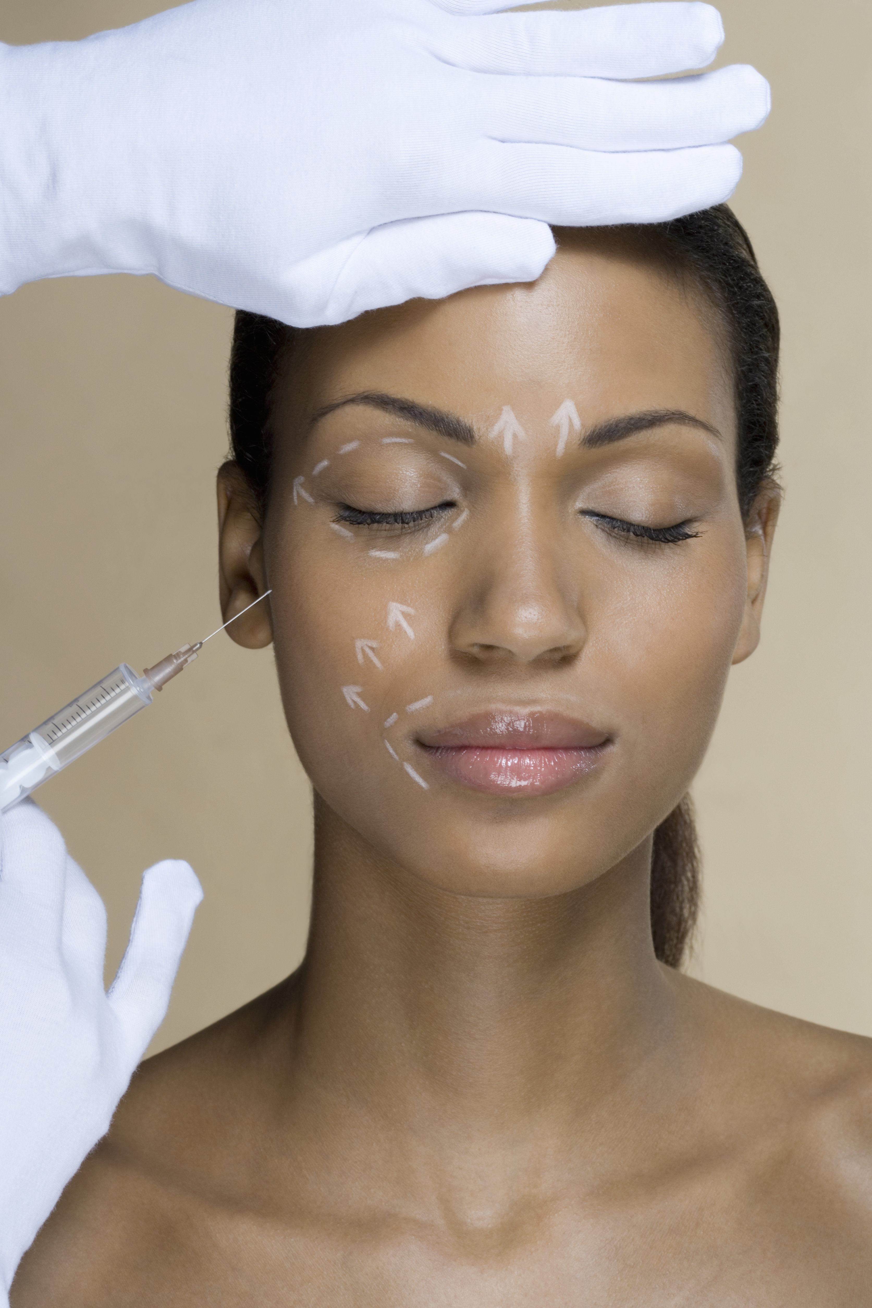 A woman with cosmetic surgery pen marks on her face