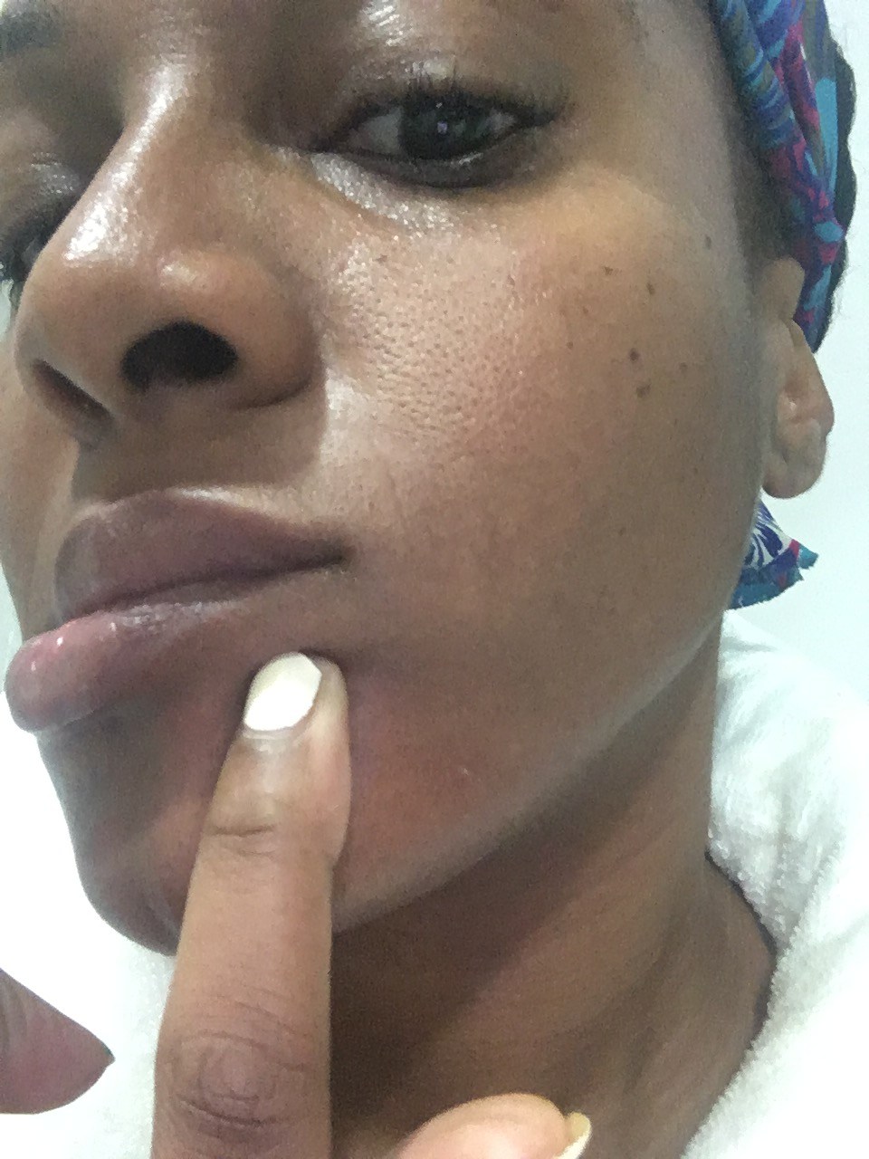 Danielle James - Laser Facial