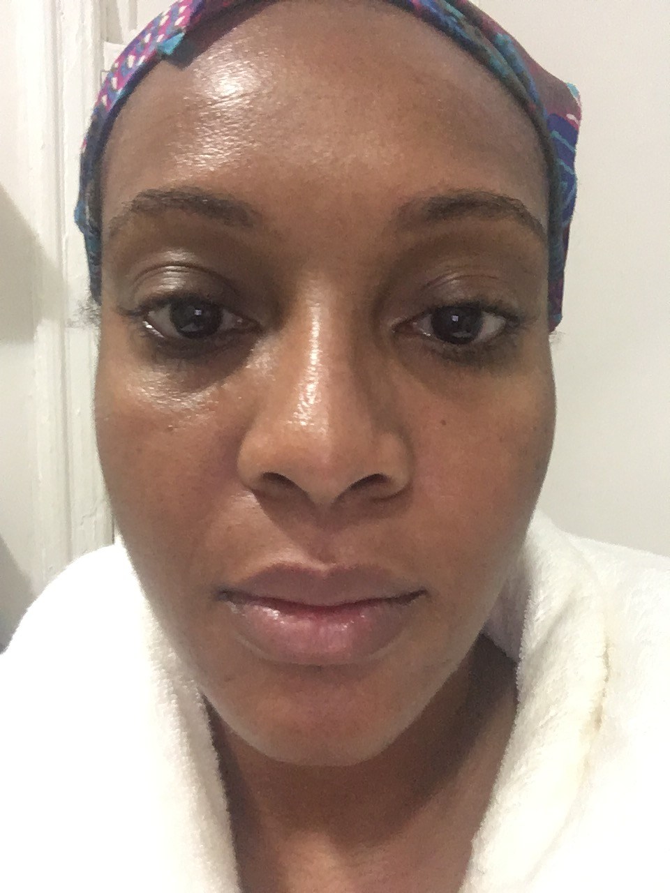 Danielle James - Laser Facial