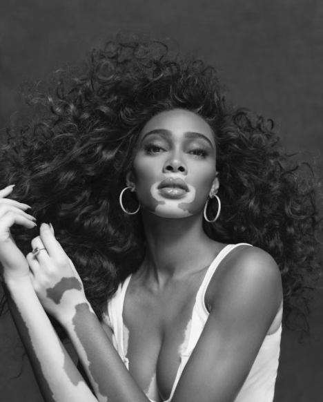 Winnie Harlow